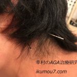 整体で後頭部に鍼を打っている様子